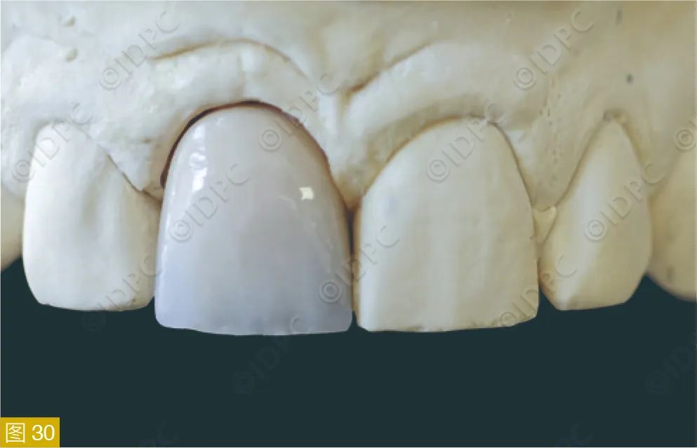 **Figure 30:** Zirconia-veneered crown on the model without artificial gingiva.