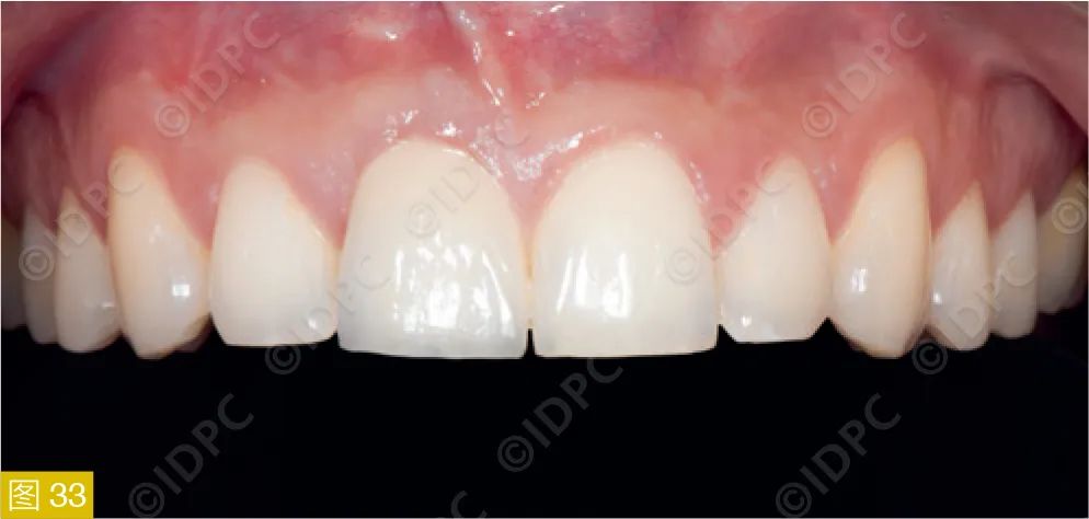 **Figure 33:** One-month post-placement of the implant-supported single crown.