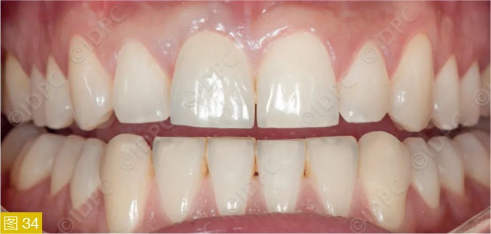 **Figure 34:** Clinical follow-up 15 months post-placement showing excellent biological and aesthetic conditions.