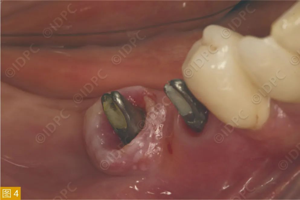 Figure 4: Clinical mucositis around an implant abutment.