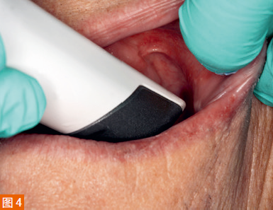 Determine the depth of the vestibular area by gently retracting the cheek with a finger.