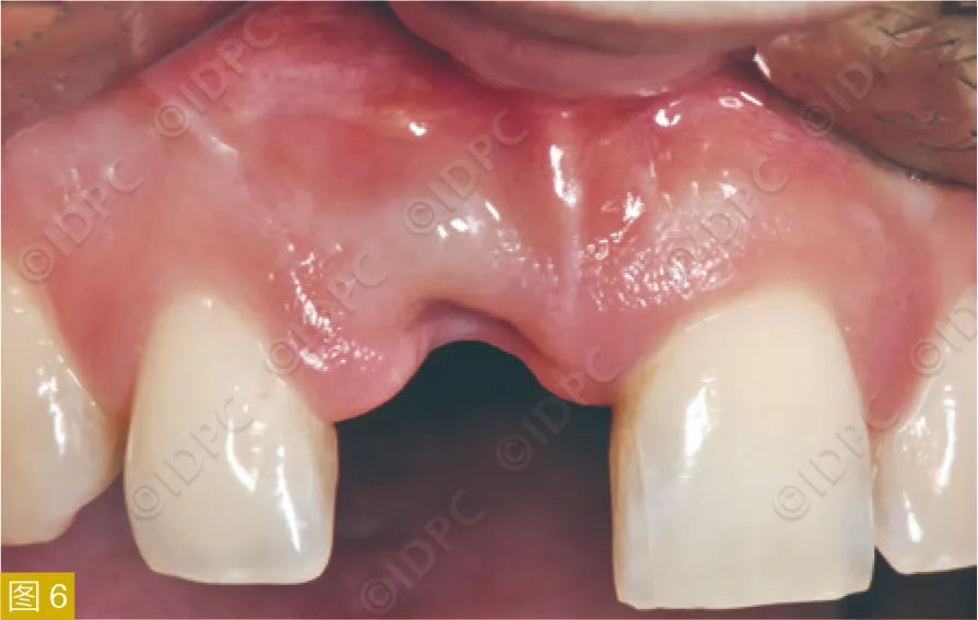 **Figure 6:** Clinical defect six weeks post-extraction.