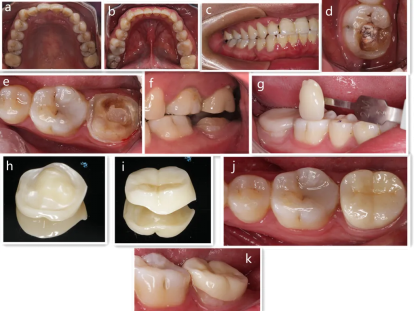 tooth preparation