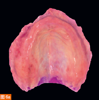 Figure 6a-d: (a) Digital impression of the maxilla in color. (b) Monochromatic maxillary scanning results. (c) Colorful mandibular scanning results. (d) Mandibular scan in monochrome.