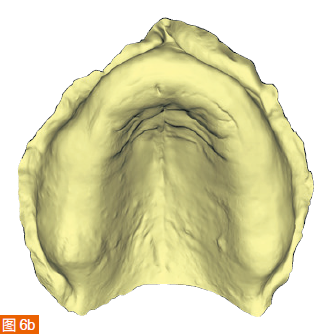 Figure 6a-d: (a) Digital impression of the maxilla in color. (b) Monochromatic maxillary scanning results. (c) Colorful mandibular scanning results. (d) Mandibular scan in monochrome.