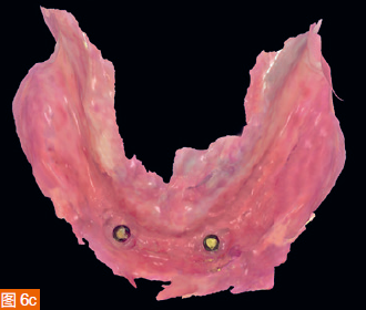 Figure 6a-d: (a) Digital impression of the maxilla in color. (b) Monochromatic maxillary scanning results. (c) Colorful mandibular scanning results. (d) Mandibular scan in monochrome.