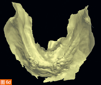 Figure 6a-d: (a) Digital impression of the maxilla in color. (b) Monochromatic maxillary scanning results. (c) Colorful mandibular scanning results. (d) Mandibular scan in monochrome.