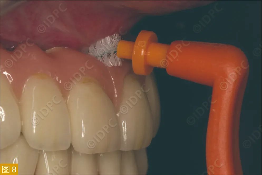 Figure 8: Cleaning fixed implant restorations with interdental brushes.