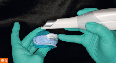 Figure 8: Scanning of median jaw relationship recordings with an intraoral scanner.