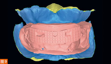 Figure 9: Virtual up𬌗 frame of intraoral digital impressions with the help of digitized Gothic bow records.