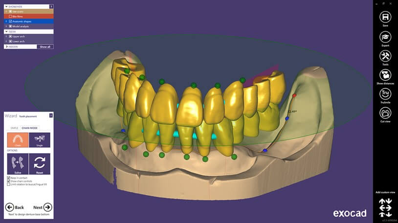 Denture Design
