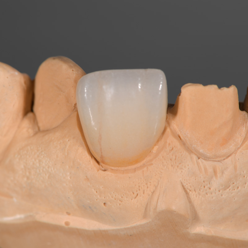 Lithium Disilicate front tooth
