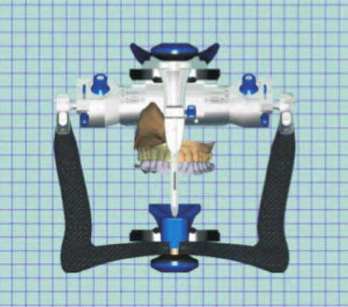 Fig.10 Using the average value frame for digital tooth arrangement and obturator design