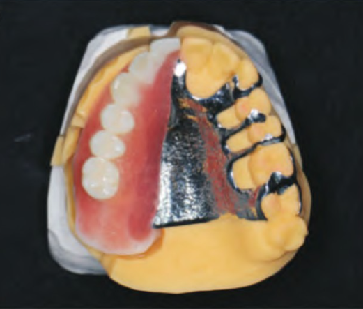 Fig.13 Seating and bonding the metal bracket and resin artificial teeth on the model to obtain the final prosthesis