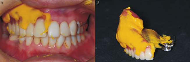 Fig.15 Applying light-body silicone rubber on the tissue surface of the prosthesis to evaluate the fit