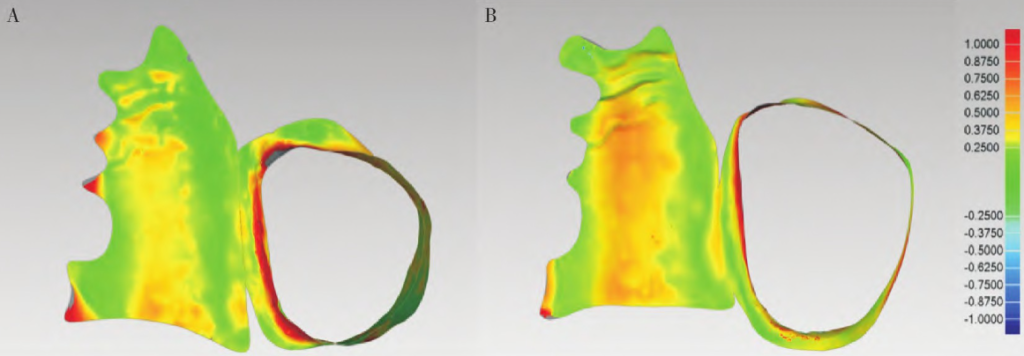 Fig.16 Deviation chromatograms of traditional and digital prostheses
Note: A, Deviation chromatogram of the fit of the traditional prosthesis; B, Deviation chromatogram of the fit of the digital prosthesis