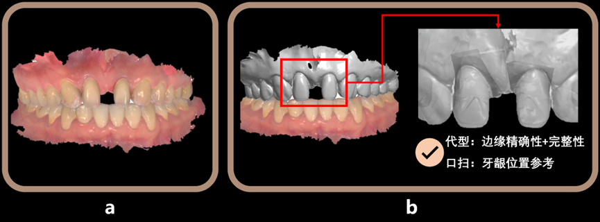 Figure 16 a is the intraoral scanning result; b is the working model combined with intraoral scan + die.