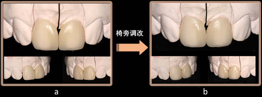 Figure 18 Chairside adjustment. a is before adjustment; b is after adjustment.