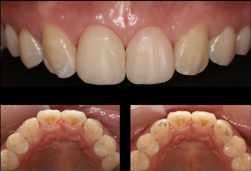 Figure 19 Intraoral image of the patient when wearing the temporary veneer.