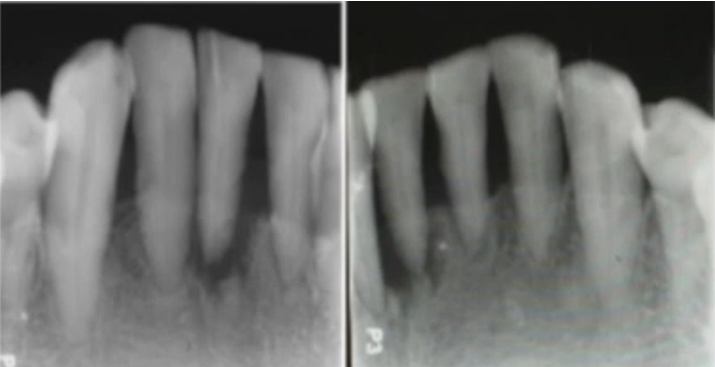 Figure 2: Periapical radiograph before treatment