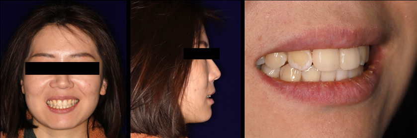 Figure 20 Facial image and lip-tooth image of the patient when wearing the temporary veneer.