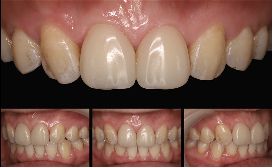 Figure 21 Intraoral image of the patient during temporary veneer review.