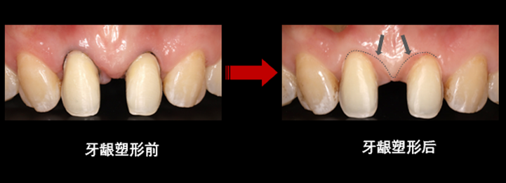 Figure 22 Gingival shaping.