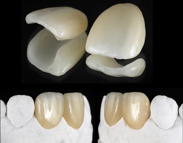 Figure 23 Appearance of porcelain veneer.