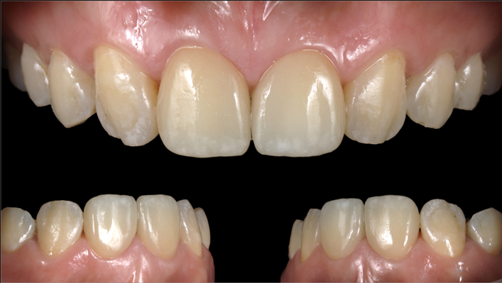 Figure 24 Intraoral image after formal restoration.