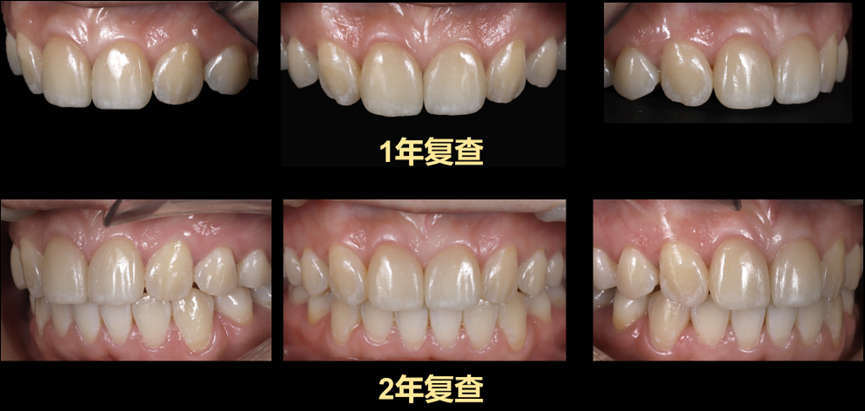 Figure 26 Intraoral images during the one-year and two-year follow-up reviews after restoration.