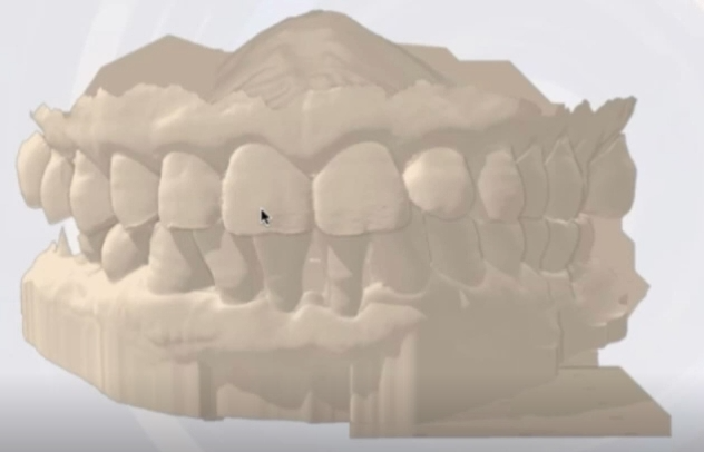 Figure 3: Intraoral digital model before tooth extraction