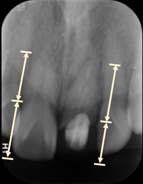 Figure 3 Periapical film of the anterior upper teeth before treatment.