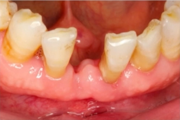 Design and Application of PEEK Periodontal Splint Combined with Autogenous Tooth for Non-Invasive Restoration: A Case Report