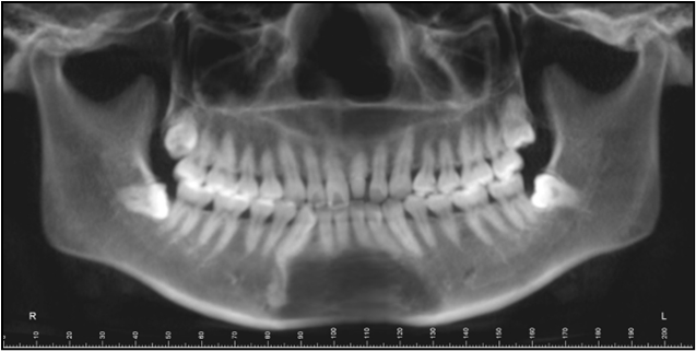 Figure 4 Panoramic tomogram before treatment.