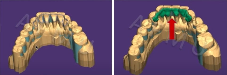 Figure 5: Computer-aided design of the PEEK periodontal splint