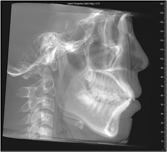 Figure 5 Cephalometric lateral film before treatment.