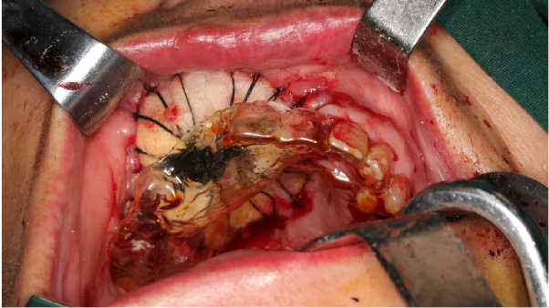 Fig.6 Inserting gauze strips into the defect cavity after the operation