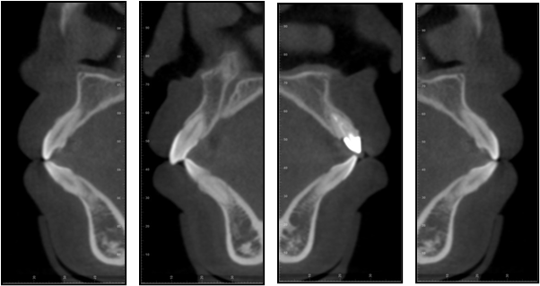 Figure 6 CBCT of the anterior tooth area before treatment.