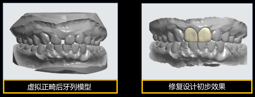 Figure 7 Virtual orthodontic post-treatment dental model and preliminary effect of restoration design.