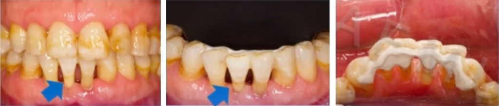 Figure 8: Immediate postoperative intraoral image