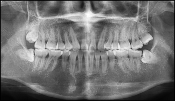 Figure 8 Panoramic tomogram after orthodontic treatment.