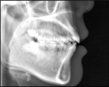 Figure 9 Cephalometric lateral film after orthodontic treatment.