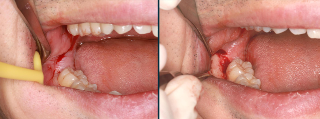 Figure 1: Raising an angulated flap to expose the bone surface of the surgical area