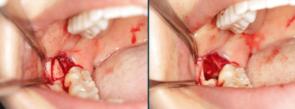 Figure 10: Carving a triangular bone window to expose the crown of tooth 48, and the bone cap was soaked in normal saline for standby