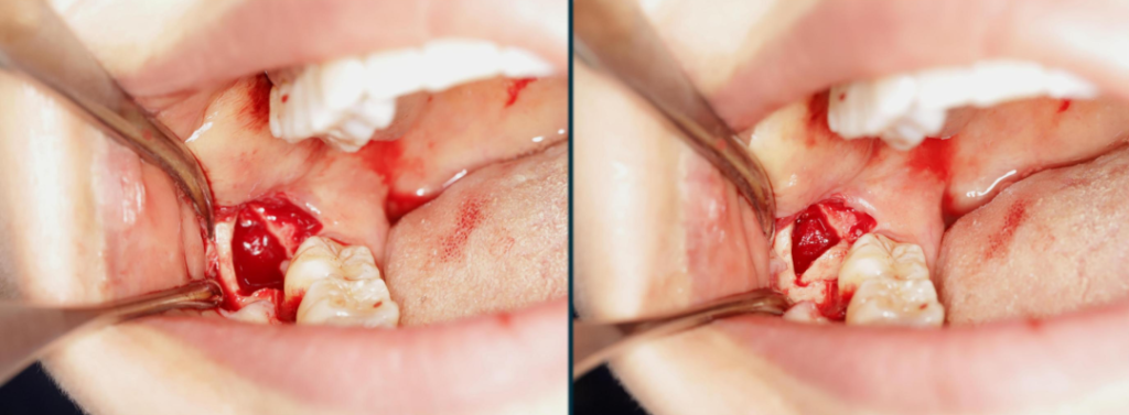 Figure 11: Rotating the triangular bone cap into place after extracting the affected tooth