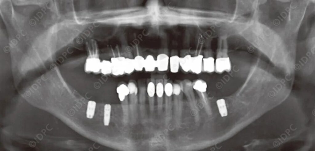 - Figure 11: Postoperative Panoramic Radiograph on January 16, 2015 (after implant placement and augmentation).