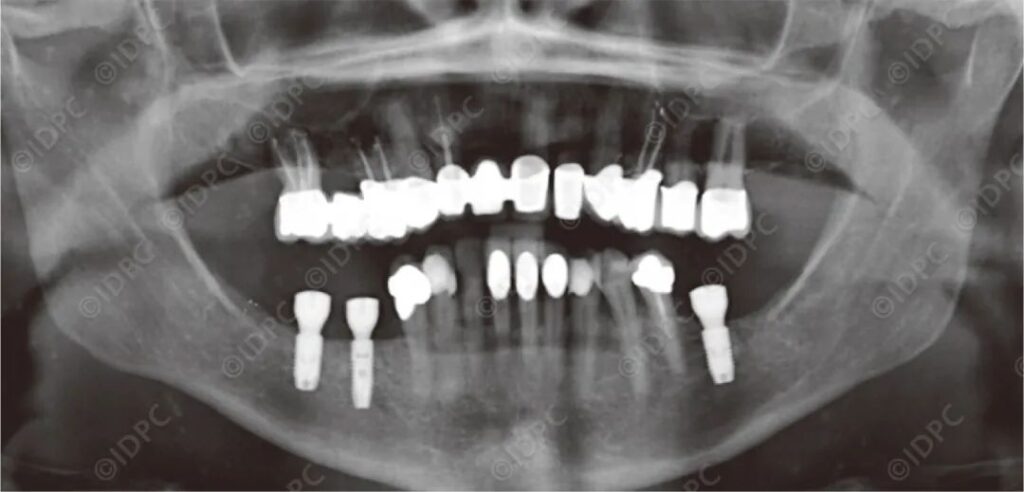 Figure 12: Postoperative Panoramic Radiograph on June 11, 2015 (after implant exposure).