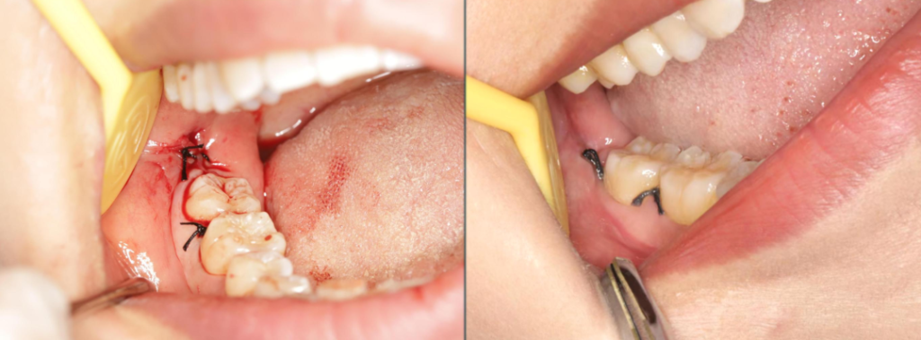 Figure 13: Suturing the wound and removing the stitches for reexamination one week later