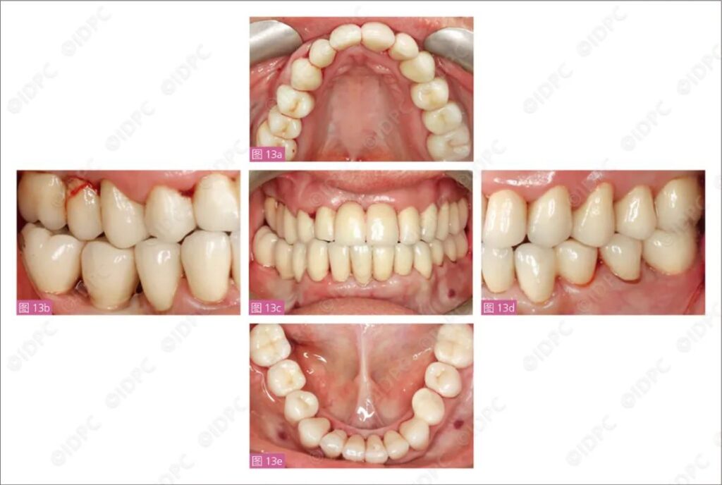 - Figure 13a-e: Clinical Photos on April 8, 2016.