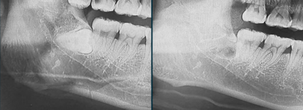 Figure 14: Comparison of panoramic radiographs before and after the operation